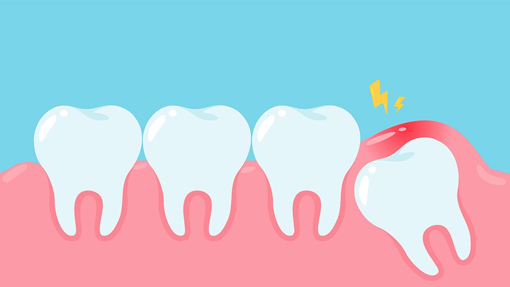 دندان عقل داندانپزشک