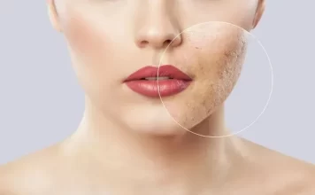 چگونه منافذ صورت خود را ببندیم چگونه منافذ صورت خود را ببندیم